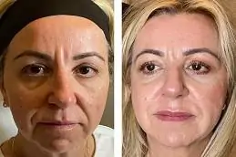 Thread Lift Before & After islamabad