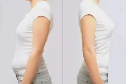 Weight Loss Injections Before & After in Islamabad